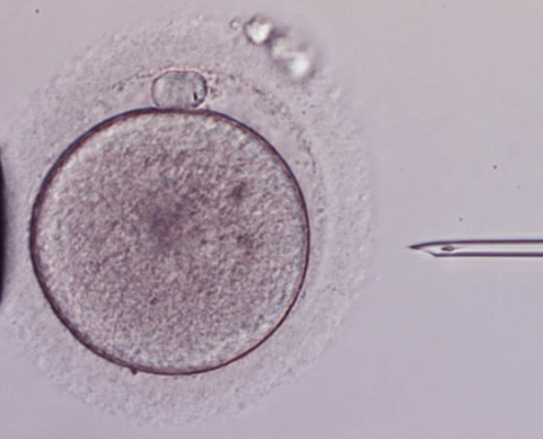 Intracytoplasmic Sperm Injection ICSI