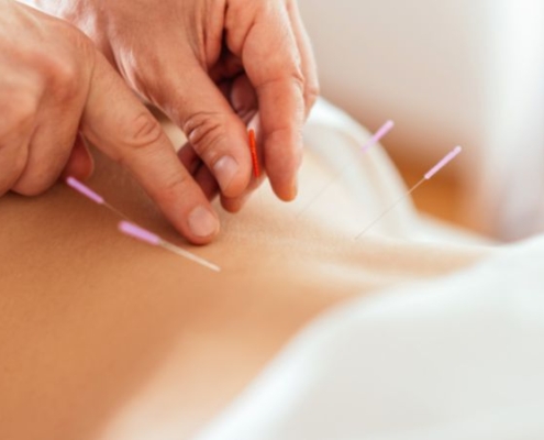 Fertility acupuncture explained